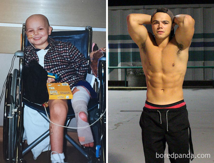 Люди, которые победили рак, в фотографиях «до и после» 