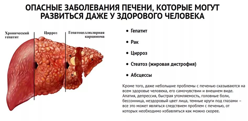 Если Болит Печень Симптомы И Лечение Диета