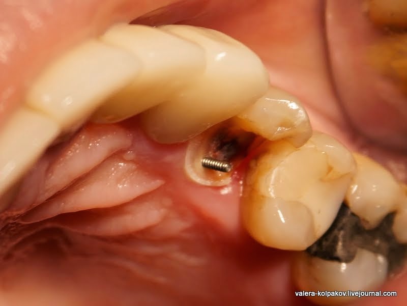 Сломался зуб, а скоро свадьба...  Сломался зуб, а скоро свадьба...