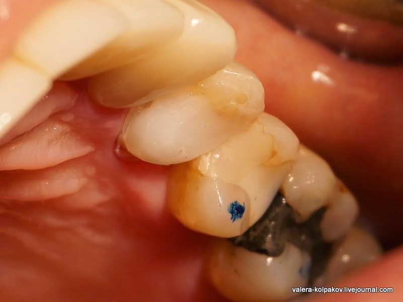 Сломался зуб, а скоро свадьба...  Сломался зуб, а скоро свадьба...