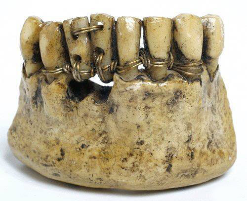  Суровая стоматология в Древнем Риме 