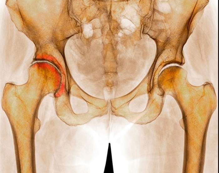 Признаки, причина возникновения и лечение артрозов тазобедренного сустава