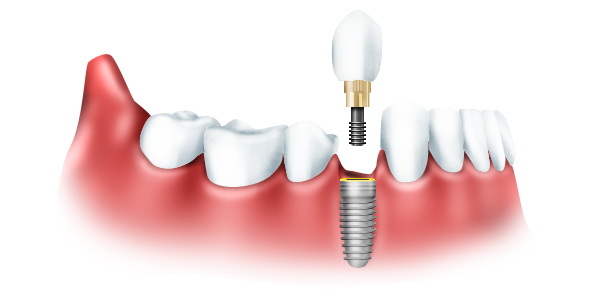 Имплантация зубов во Владимире