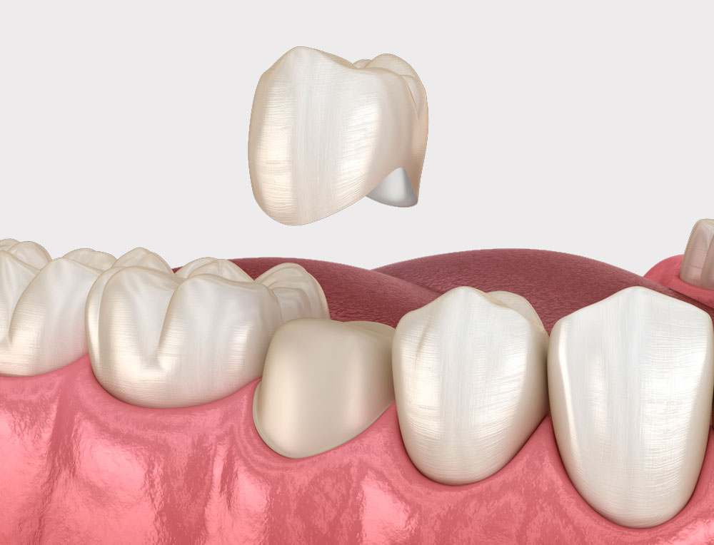 Коронки из диоксида циркония: особенности, кому показаны
